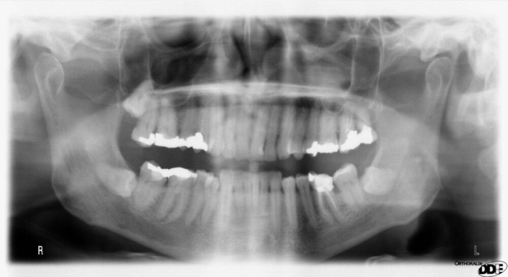 wisdom teeth x-ray